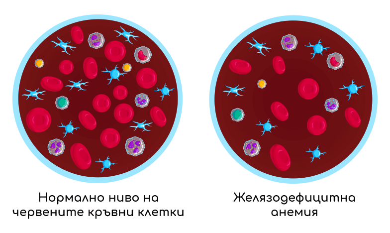 Желязодефицитна анемия